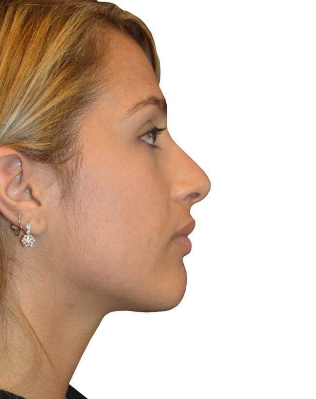 Rhinoplasty Patient 14 - After - 1