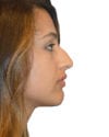 Rhinoplasty Patient 14 - Before - 1 thumbnail