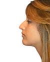 Rhinoplasty Patient 14 - After - 1 thumbnail