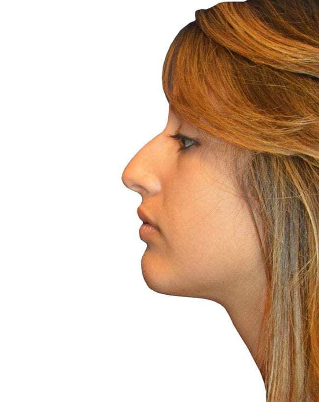Rhinoplasty Patient 14 - After - 2