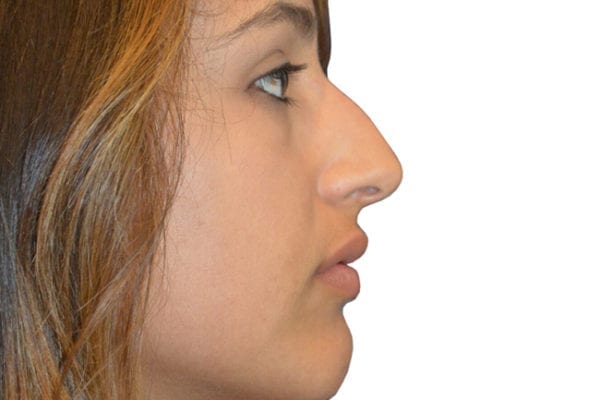 Rhinoplasty Patient 14 - Before - 1 Carousel Thumbnail
