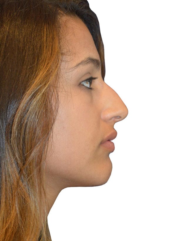 Rhinoplasty Patient 14 - Before - 1