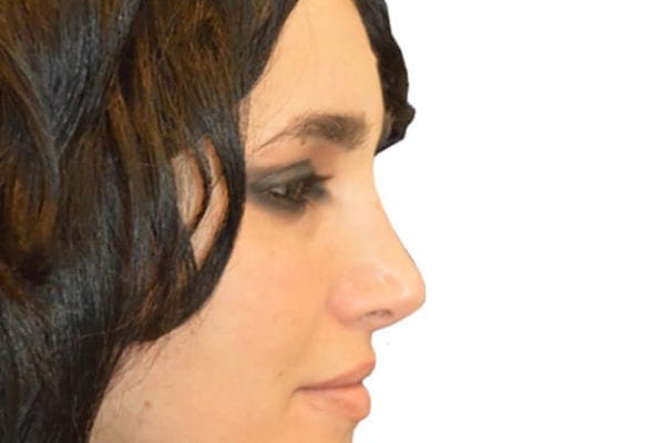 Rhinoplasty Patient 08 - After - 1 Carousel Thumbnail