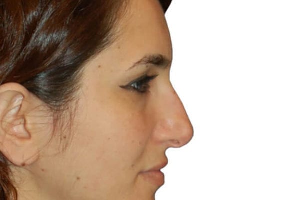 Rhinoplasty Patient 08 - Before - 1 Carousel Thumbnail