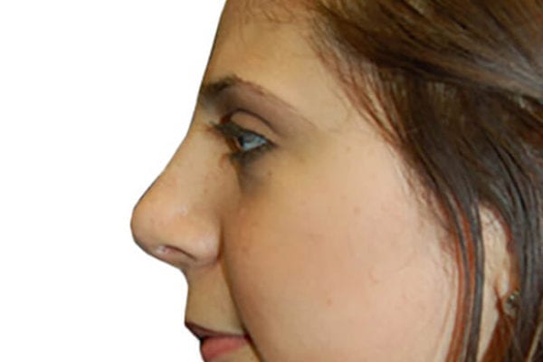 Rhinoplasty Patient 09 - After - 1 Carousel Thumbnail