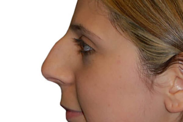 Rhinoplasty Patient 09 - Before - 1 Carousel Thumbnail
