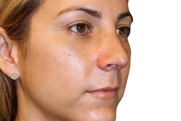 Rhinoplasty Patient 16 - After - 1 Carousel Thumbnail