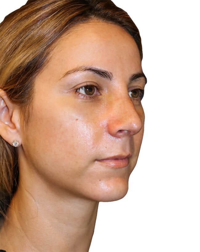 Rhinoplasty Patient 16 - After - 1