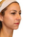 Rhinoplasty Patient 16 - Before - 1 thumbnail