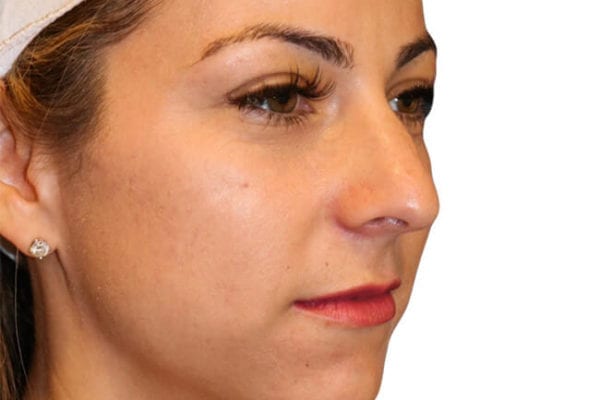 Rhinoplasty Patient 16 - Before - 1 Carousel Thumbnail