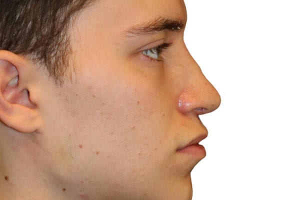 Rhinoplasty Patient 07 - After - 1 Carousel Thumbnail