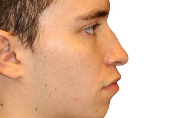 Rhinoplasty Patient 07 - Before - 1 Carousel Thumbnail