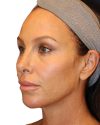 The Diamond Facial Sculpting Patient 27 - Before - 1 thumbnail