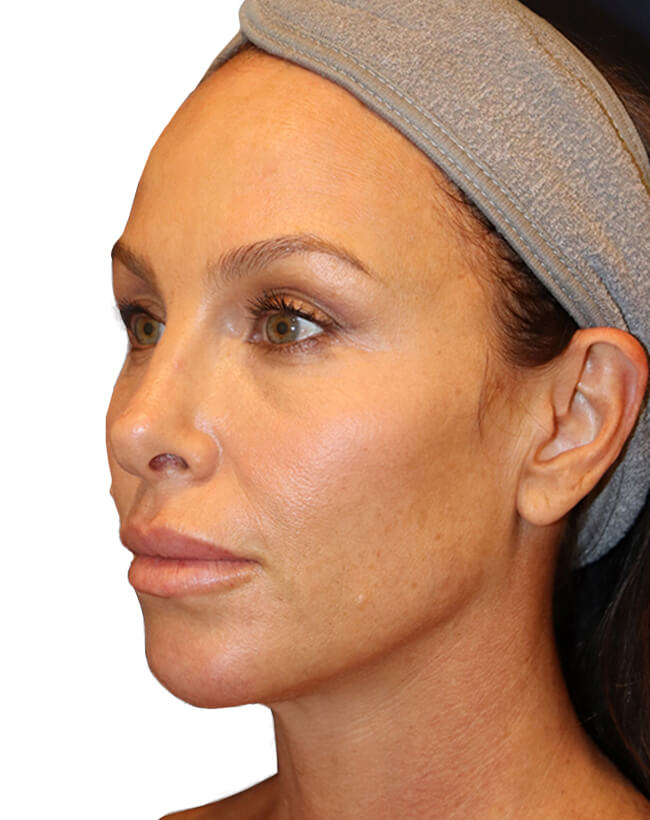 The Diamond Facial Sculpting Patient 27 - Before - 2