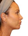 The Diamond Facial Sculpting Patient 27 - Before - 1 thumbnail