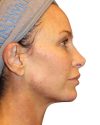 The Diamond Facial Sculpting Patient 27 - After - 1 thumbnail
