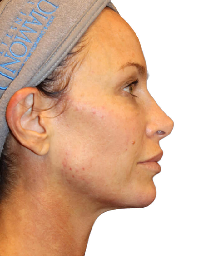 The Diamond Facial Sculpting Patient 27 - After - 3