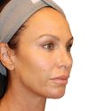 The Diamond Facial Sculpting Patient 27 - Before - 1 thumbnail