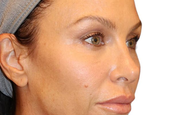 The Diamond Facial Sculpting Patient 27 - Before - 1 Carousel Thumbnail