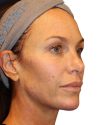 The Diamond Facial Sculpting Patient 27 - After - 1 thumbnail