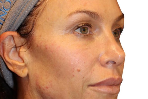 The Diamond Facial Sculpting Patient 27 - After - 1 Carousel Thumbnail