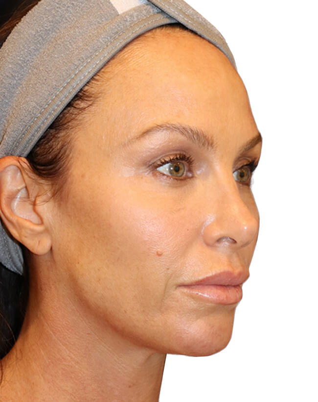 The Diamond Facial Sculpting Patient 27 - Before - 1
